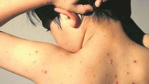 126% increase in hospitalisations from chickenpox 126% increase in hospitalisations from chickenpox