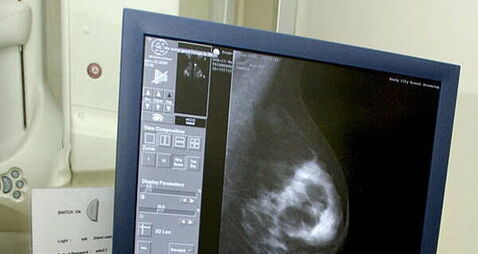 Tipperary nurse sues over alleged delay in breast cancer diagnosis